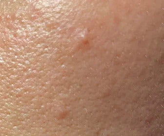 Skincare pelle grassa