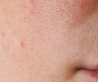 Skincare pelle sensibile