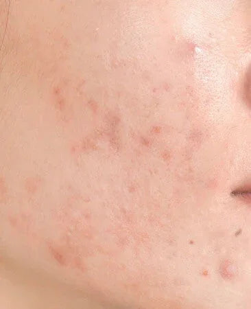 Skincare pelle impura