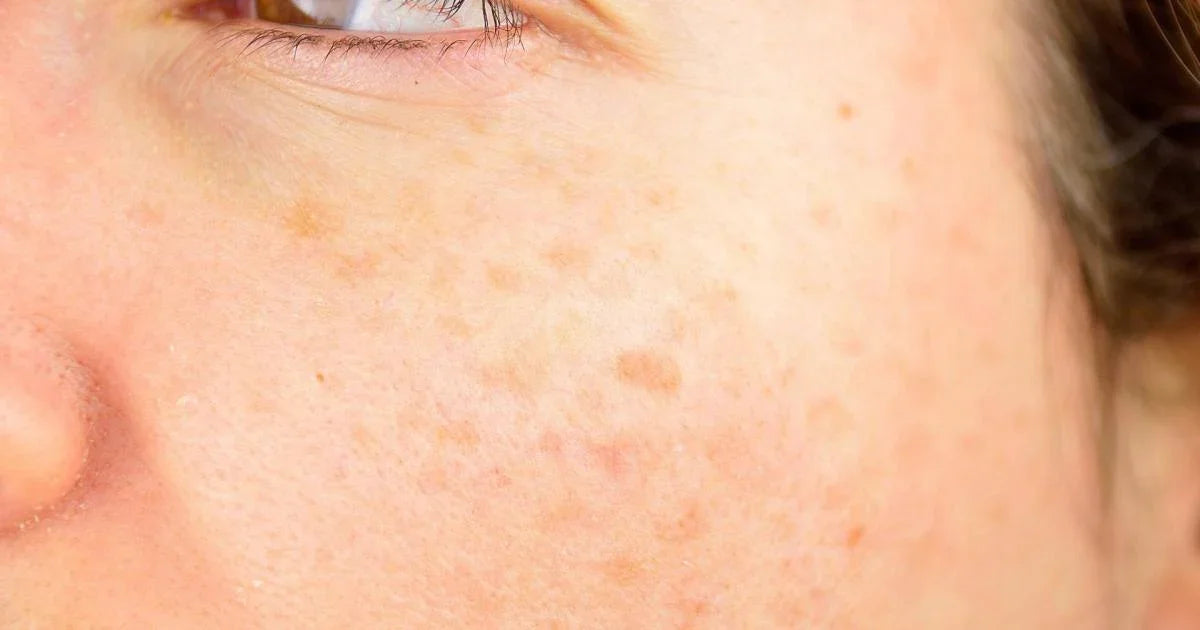 Skincare pelle con macchie