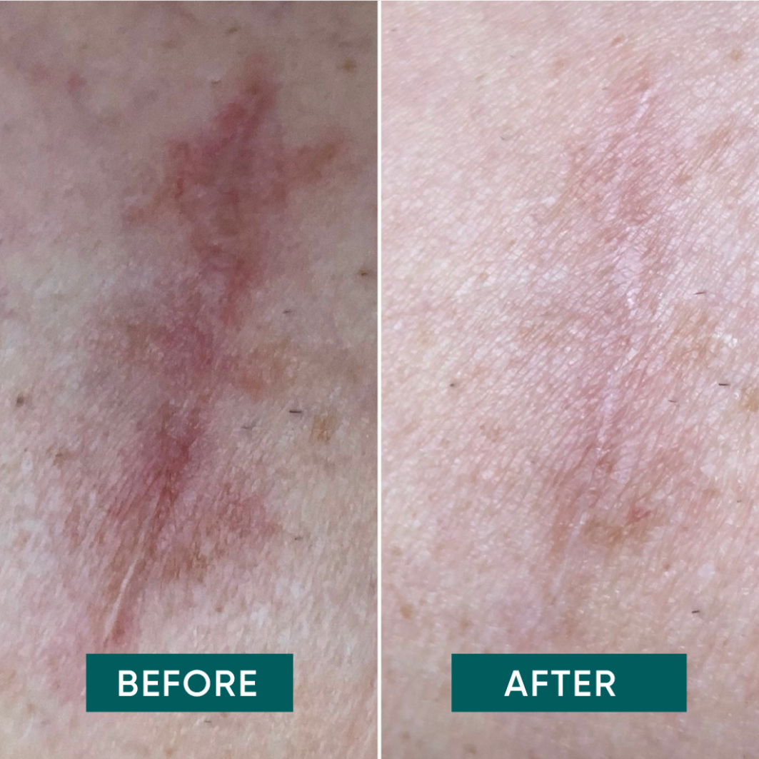 BEAUTY PATCH RIUTILIZZABILI CON ALOE VERA PER LE CICATRICI