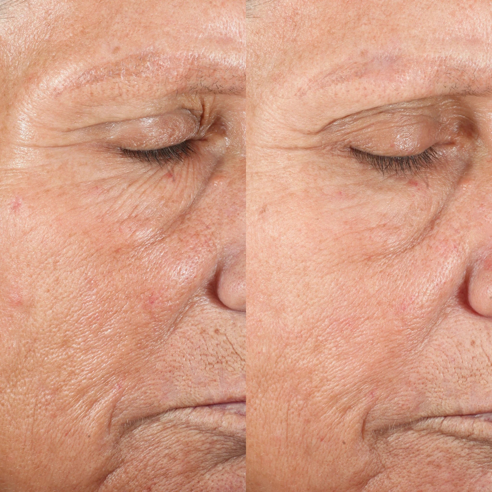 Pmd Elite Pro | Wireless - Microdermoabrasione viso professionale uso casa