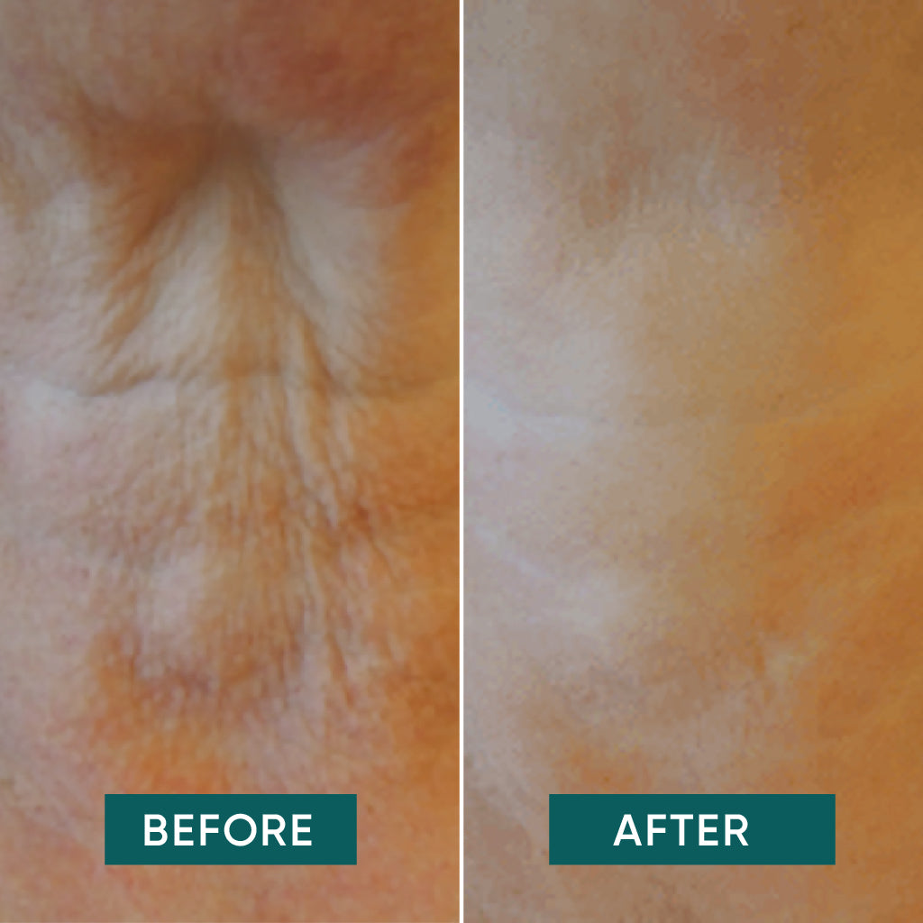 BEAUTY PATCH RIUTILIZZABILE CON ACIDO IALURONICO PER IL COLLO